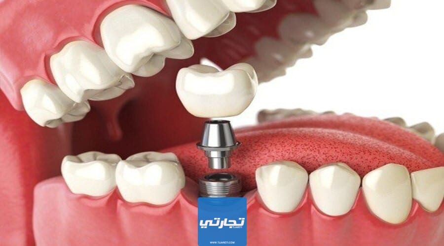 أفضل مراكز زراعة الأسنان في السعودية