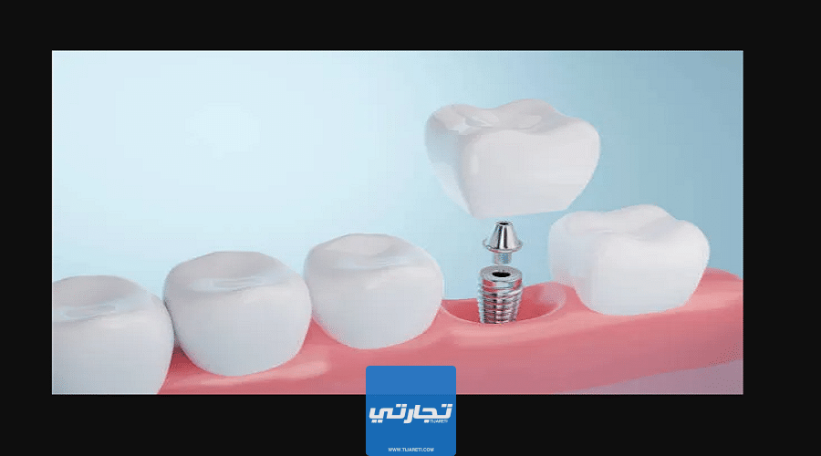 افضل عيادة زراعة اسنان في الرياض | الخبرات والتقنيات