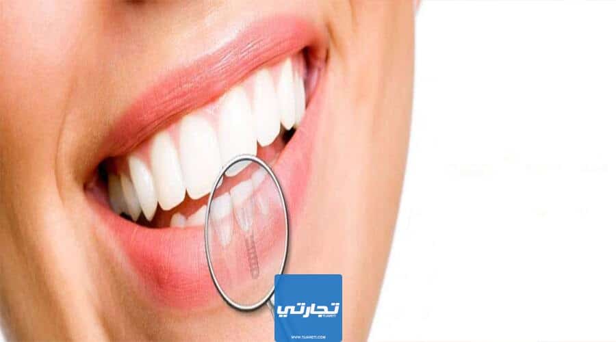 عوامل تتحكم في تكلفة زراعة الأسنان في السعودية