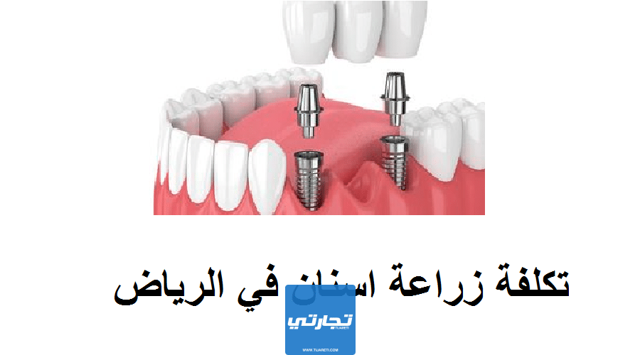 افضل عيادة زراعة اسنان في الرياض | الخبرات والتقنيات